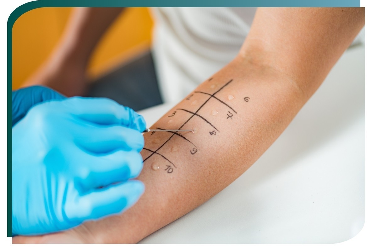 Teste cutâneo (Prick Test)