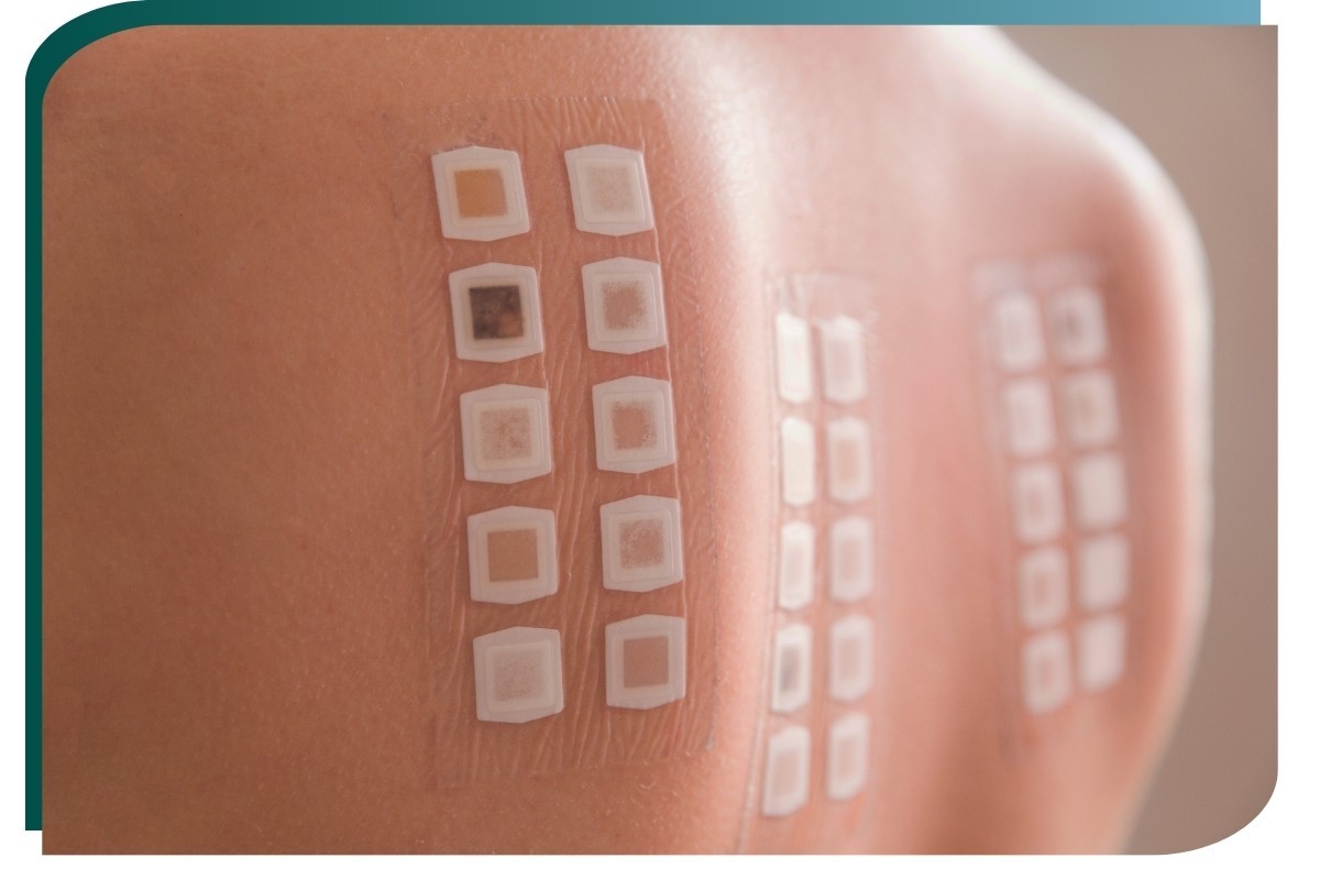 Teste de contato (Patch Test)